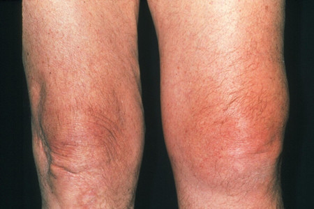 类风湿关节肿胀变形了是不是畸形残疾的信号