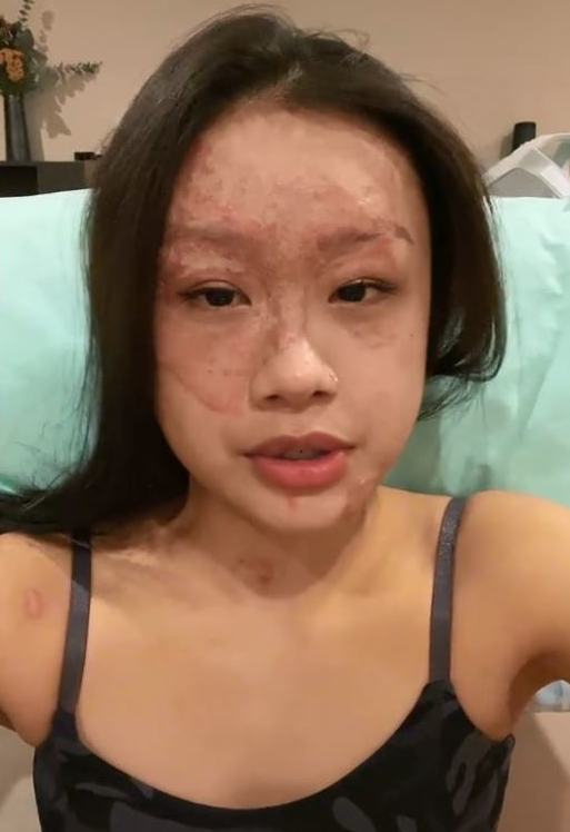 女子和男友在家炸甜甜圈拿水冲油锅引发爆炸致毁容