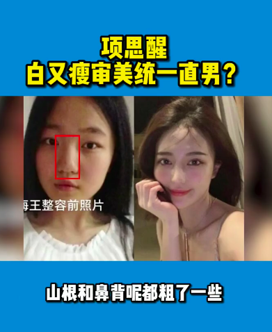 项思醒整容前后差异太大!up主分析其做了10个项目,全脸基本都动过