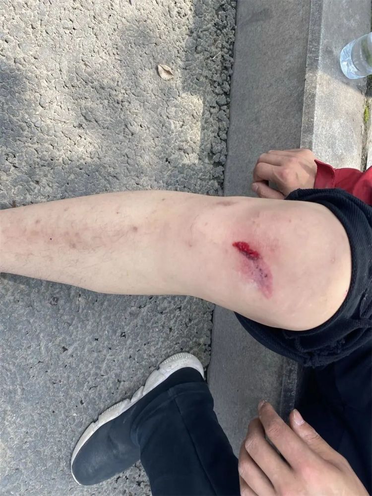 一名乘客腿部暂时无法受力,小货车驾驶员腿部受伤流血,其他人员暂无大