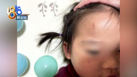 二十多天过去了,孩子的伤口已经基本愈合,但额头这里还是有一道疤痕