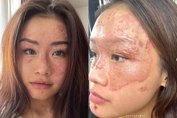 女孩在家做饭因一个错误动作致热油锅瞬间炸开 半张脸灼伤毁容