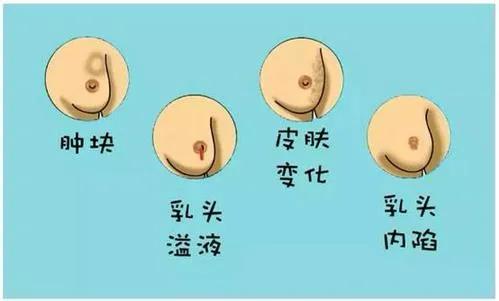 早期乳腺癌症状快来看看自己有没有