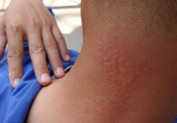 经过主治医师的悉心诊断,发现是感染了hpv病毒.