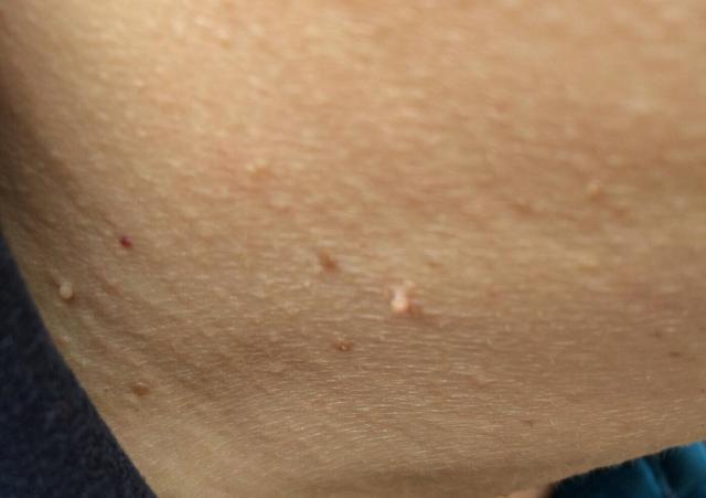 正如我们的皮肤很容易长痣一样,小肉粒有时候可以是粉刺,有时候可以