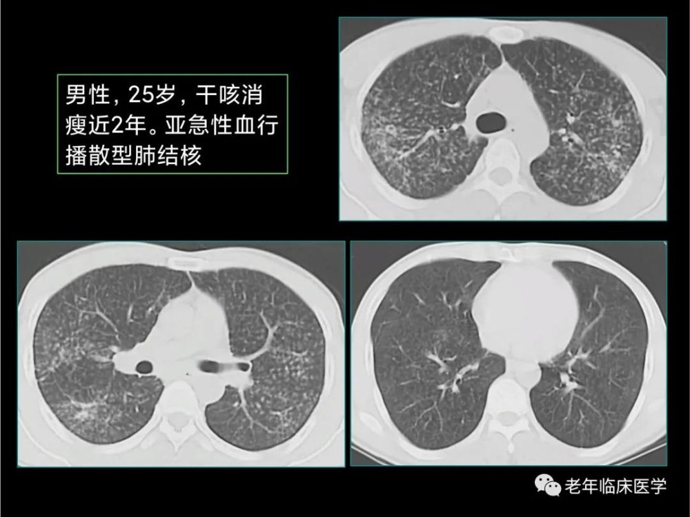 珍藏版ct系列之九肺結核