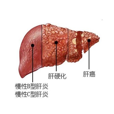 哑巴肝不说话,我们就对它一无所知,你的肝还好吗?