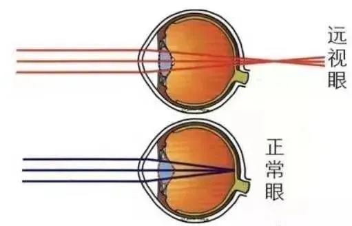 家有12岁以下孩子的家长请注意,呵护好孩子远视储备!