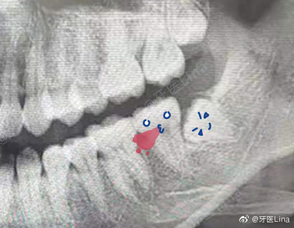 看不到智齒沒有智齒別高興得太早可能它藏在骨頭裡