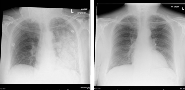 如何在胸部 ct 上秒判急性心衰肺水肿?