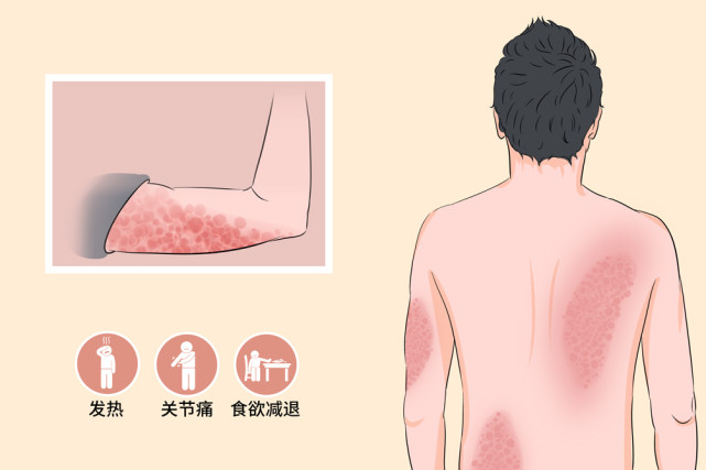 硬皮病屬於結締組織病會累及皮膚主要用藥物治療預後較好