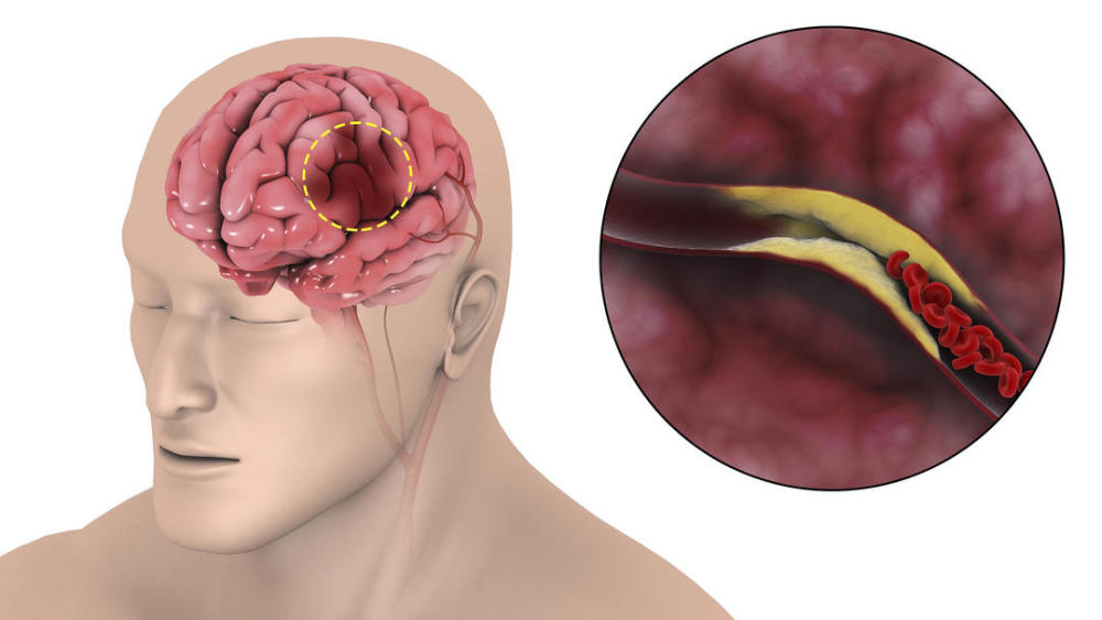 预防脑血管疾病应尽早开始,几个信号预示发病