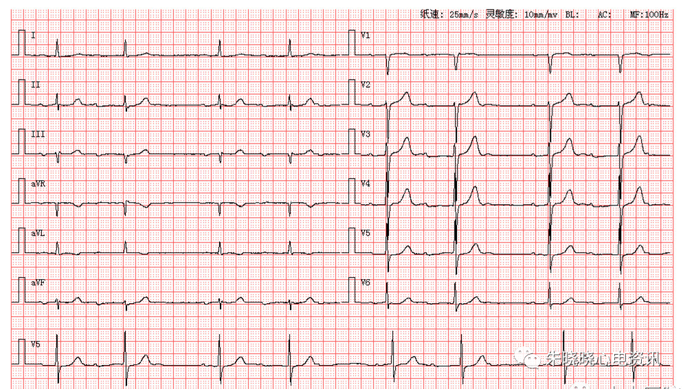 每日读图|第1355期 二度一型房室传导阻滞_腾讯新闻