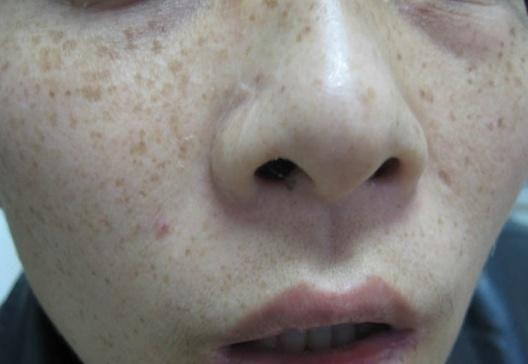 5种斑点的护肤方法若是坚持麻子脸变光滑奶油肌男神看了都心动