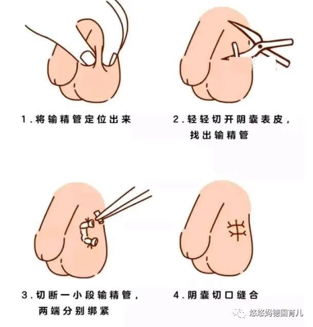 德国人喜欢哪种避孕方式生完二胎我的德国丈夫主动说要去做结扎