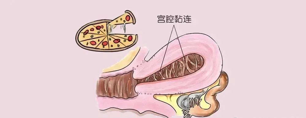 造人须得子宫强,那宫腔粘连如何诊治?_腾讯新闻