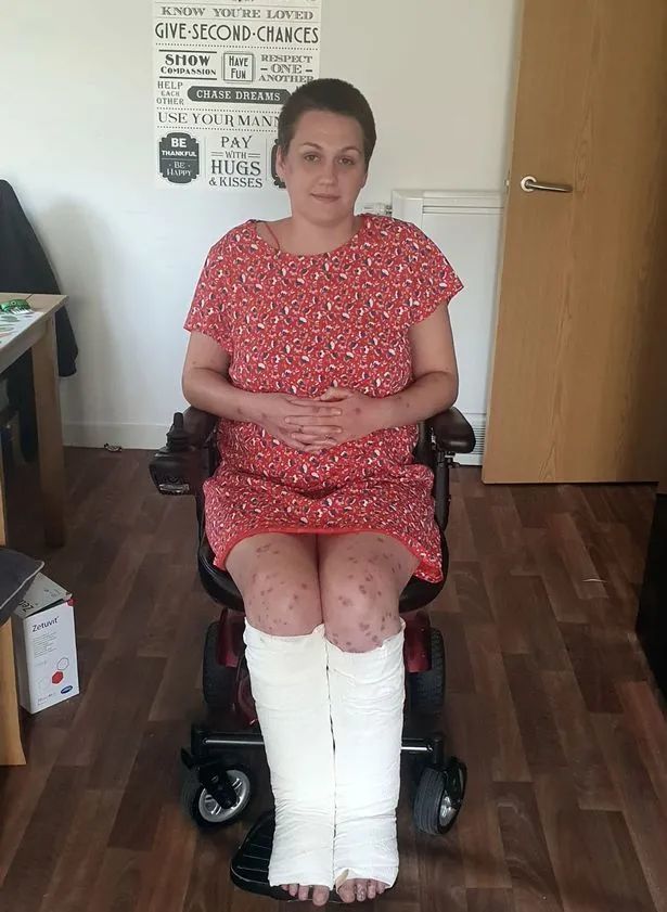 慎点英女子注射新冠疫苗结果腿部长满水泡