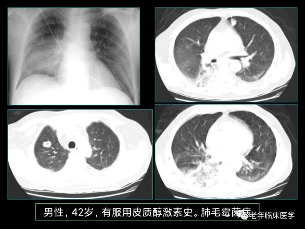 珍藏版ct系列之十肺部真菌感染及寄生蟲病