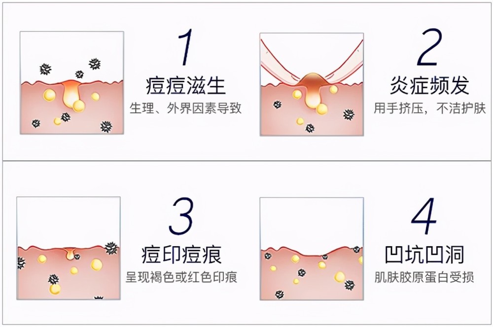 1,暗瘡印會隨著新陳代謝消除 其實暗瘡印會跟隨著人體的新陳代謝日益