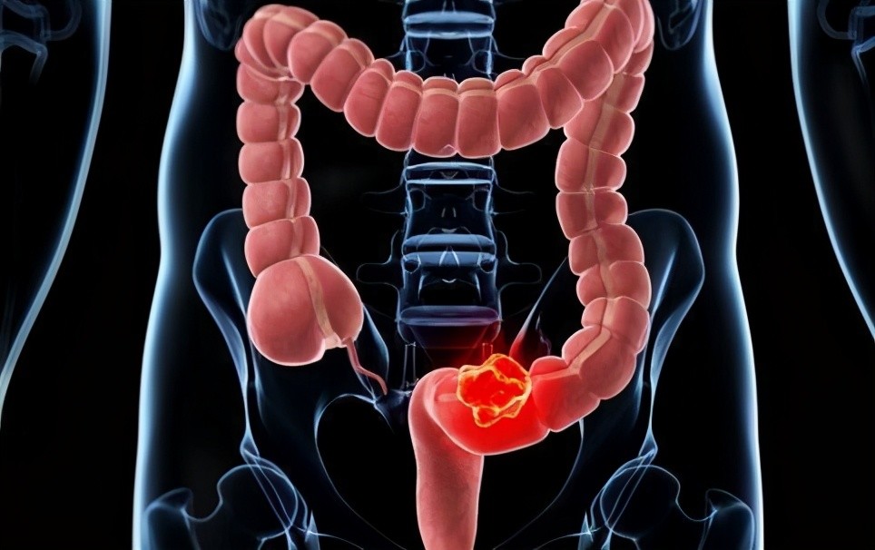 原來大便早就提醒了腸癌的到來由於忽視4種情況現在後悔莫及