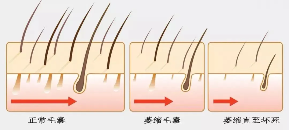 毛囊死亡图片