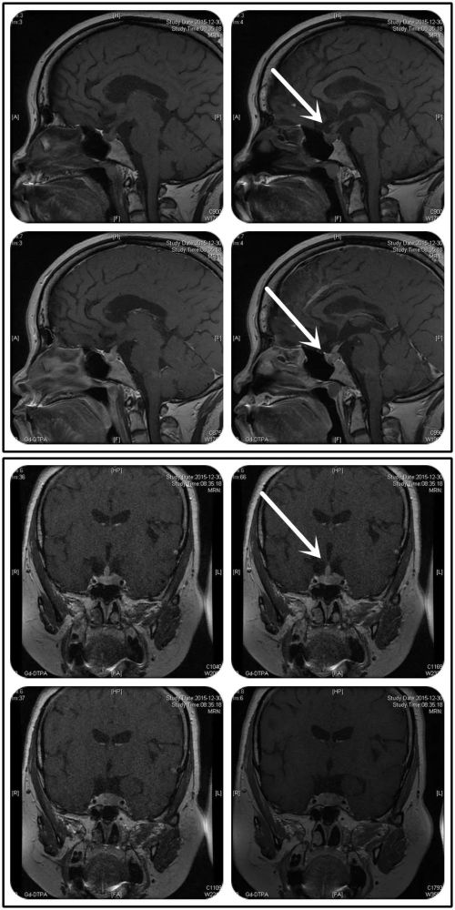 内分泌科住院确诊库欣病,影像学提示垂体左侧不规则腺瘤伴垂体柄增粗