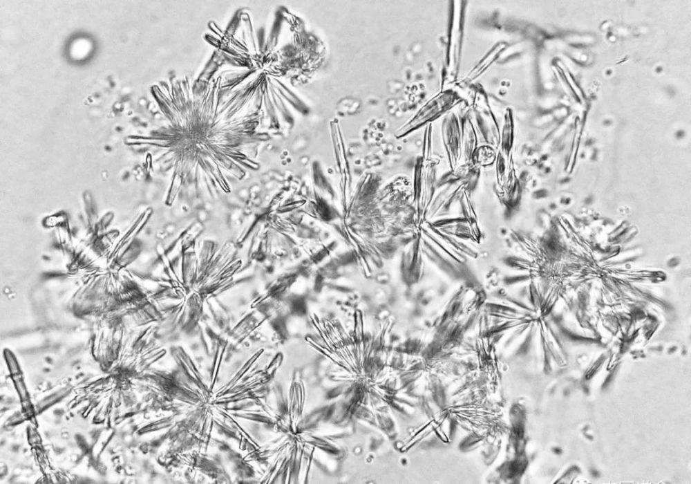 非晶形磷酸盐结晶:常见于中性～碱性尿,可溶解于盐酸或乙酸,不溶解于