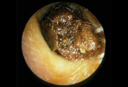 彻底去除狐臭最有效的方法让你重新出发