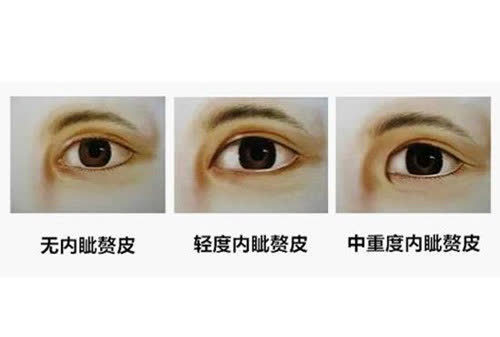 长期聚居形成了某些种群的特征,铲形门齿只是其一,眼内眦褶则是其二