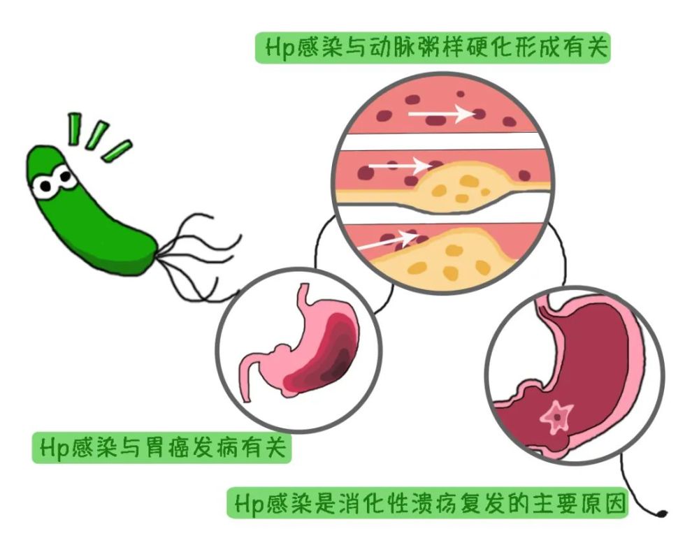 查查健康小課堂兒童感染幽門螺旋桿菌怎麼辦