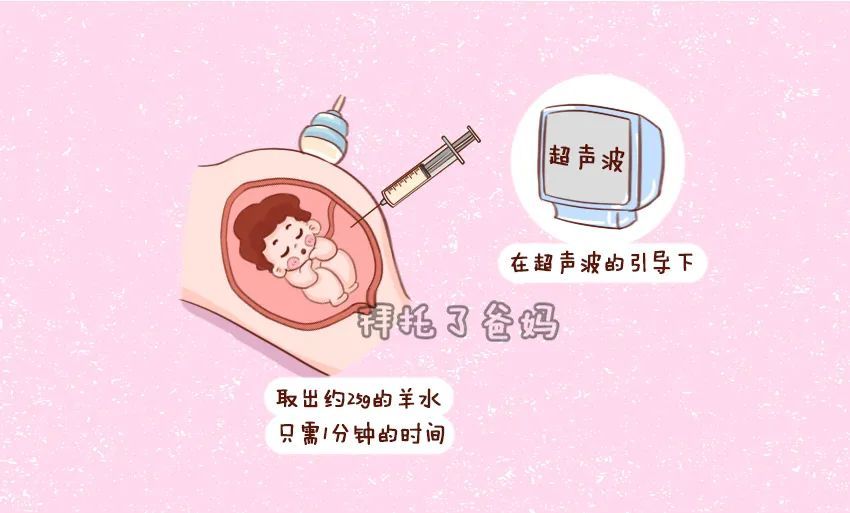 孕期要做羊水穿刺吗 这几类孕妈妈需要做 腾讯新闻