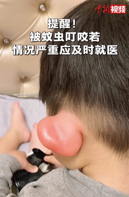 心疼又好笑男孩被蚊子叮成大耳朵图图肿得都发亮了