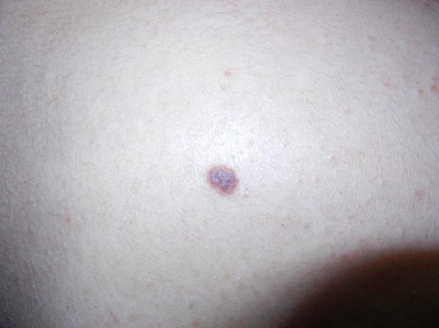 再三提醒:长在3个地方的痣,或与癌症"紧密相关",要重视