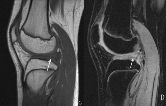 膝關節各種損傷的mri表現大集合
