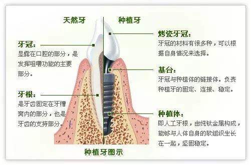 种植牙可以用一辈子吗?有人这么回答!