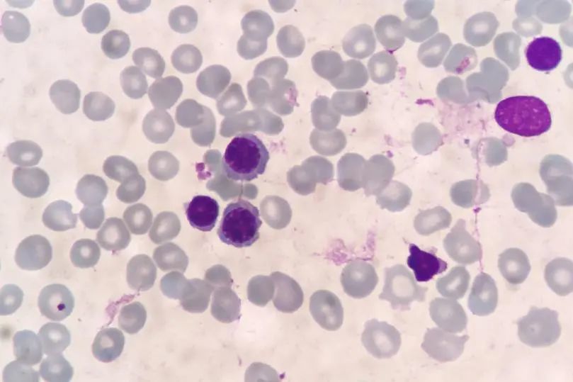 骨髓细胞学检查:肝肾功能检查:总胆红素23.3(5.1-17.