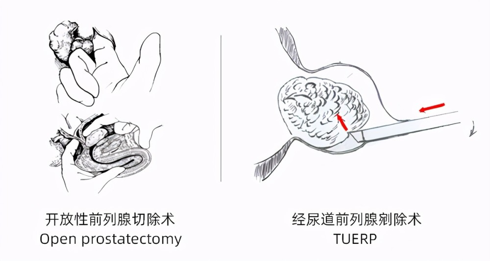 美,亚太等30多个国家,地区进行手术表演和学术讲座,"经尿道前列腺剜除
