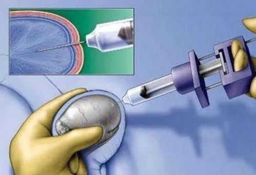 健康备孕男性患先天性输精管缺如还能做试管婴儿吗