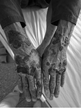 (湖南省脑科医院)躯体疾病精神科就诊,被诊断为卟啉病伴性焦虑障碍