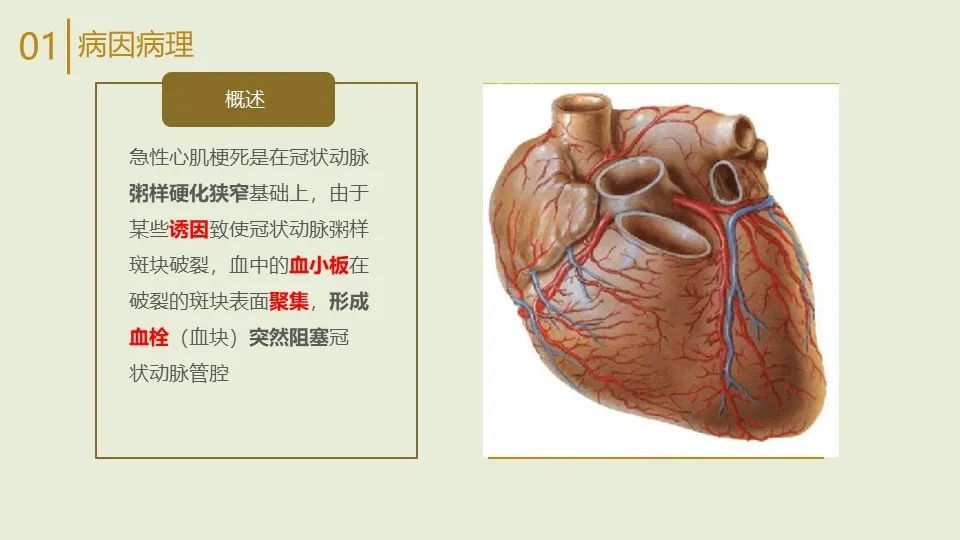 ppt一例心肌梗死患者的护理