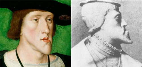 这种"哈布斯堡下巴"就是俗称的颅面骨畸形,英国曼彻斯特有一位名叫