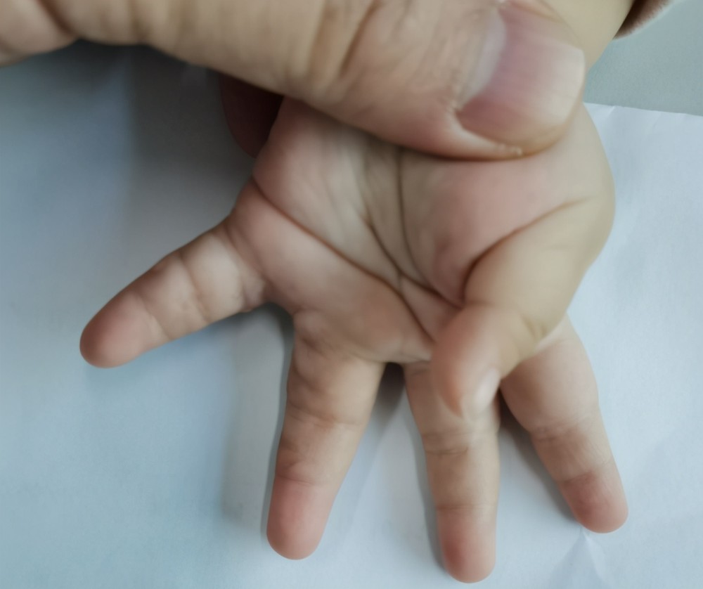 严重的可以五指并指,小手成铲状,拳状;轻者指蹼只比常人浅一点,不影响