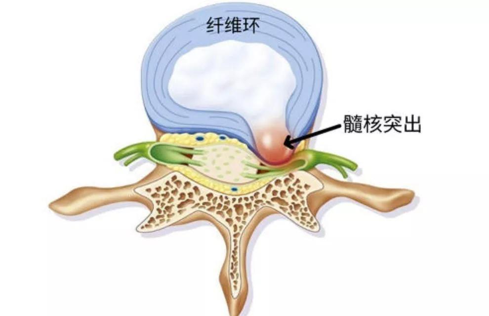 腰椎退行性病變的原因一