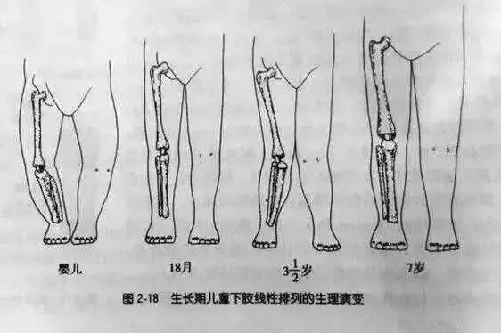 出汗多枕秃出牙晚o型腿睡觉不安这些缺钙信号孰真孰假