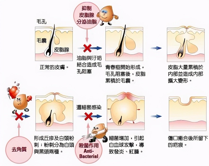 针清可以治疗痘痘吗效果好吗
