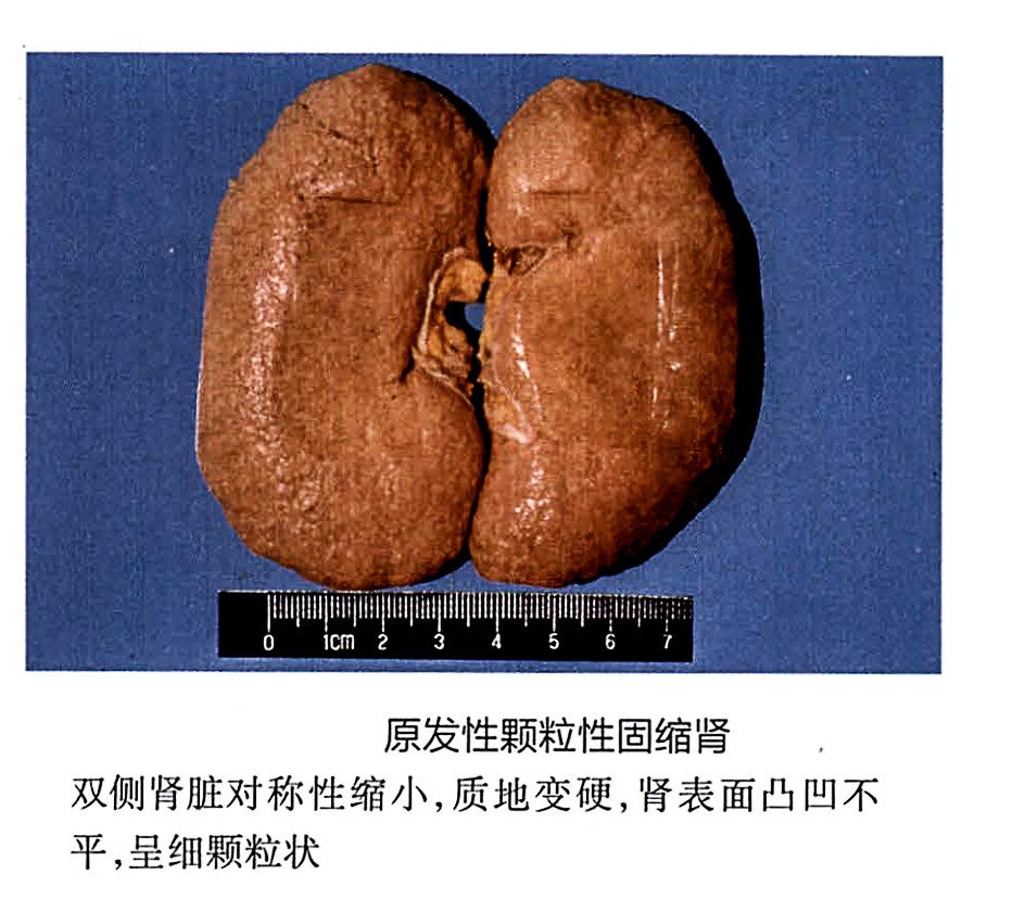 这么多人患有高血压高血压的最大危害是什么