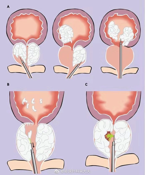 是因为这1器官变大了|前列腺|尿道|膀胱|手术治疗|前列腺增生