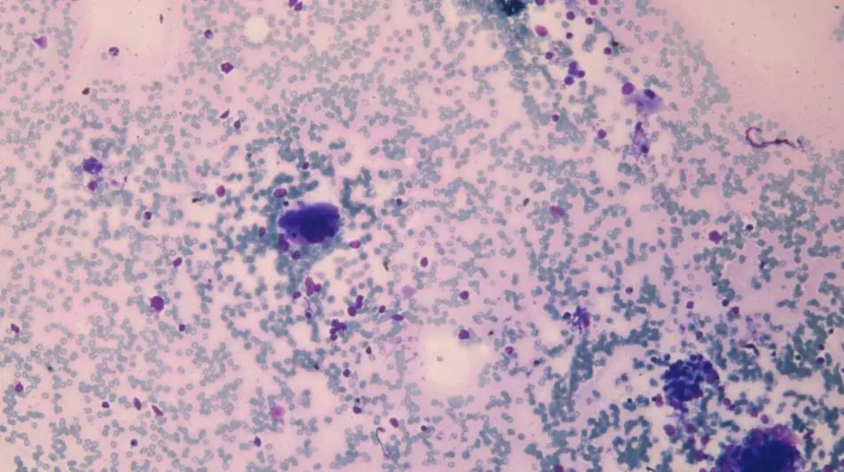 骨髓穿刺及骨髓细胞形态学,骨髓象分析(图2-5):取材,涂片,染色良好