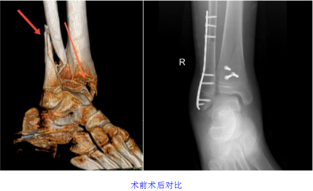 胖小伙高处跳下致骨折 为何骨科医生 拒绝 立即手术 腾讯网