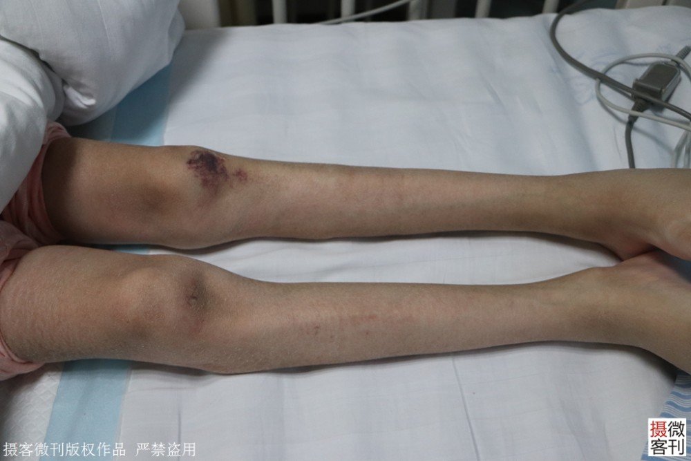 女孩患病双腿瘦成皮包骨妈妈24小时守护女儿还想跳舞